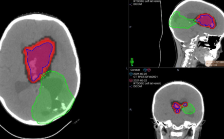 Scan of reirradiation of recurrent tumor